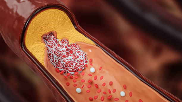 Лечение атеросклероза аорты народными средствами: эффективные методы и рекомендации